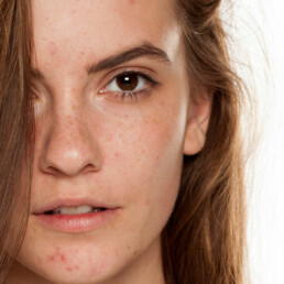 Beautiful women with freckles