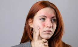 Women with Rosacea Skin condition around the face