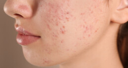 A close up of a person with acne