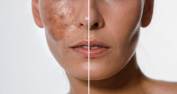 Before and after of melanin treatment